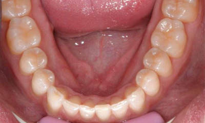 straight smile after Invisalign | dentist allentown pa