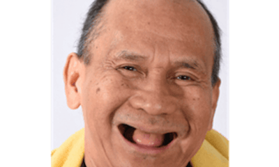 Before treatment - Complete Dentures