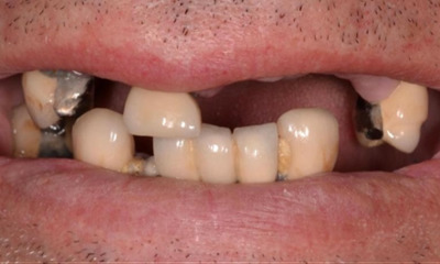 missing teeth before dentures | allentown dentist