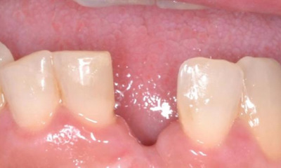 close up of missing front tooth | dental implant allentown pa