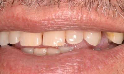 fractured tooth before dental treatment | allentown dentist
