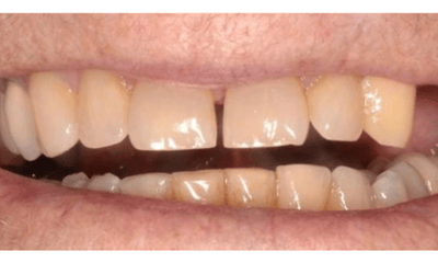 missing teeth before dental implants | allentown dentist