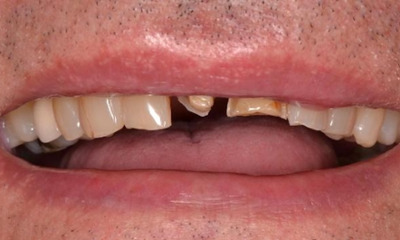 broken teeth before dental crowns | allentown dentist