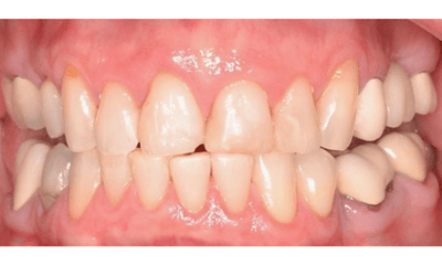 dingy teeth before smile makeover l allentown dentist