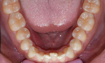 misaligned teeth before dental treatment l invisalign allentown pa